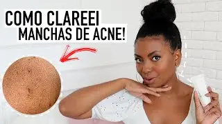 COMO CLAREAR MANCHAS EM PELE NEGRA! VEJA COMO &Eacute; F&Aacute;CIL E R&Aacute;PIDO Camila Nunes