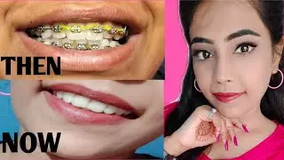 My braces journey //experience with braces//lets talk about braces//Akanksha soni. #bracesjourney