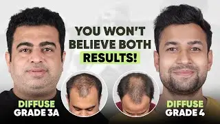 Hair Transplant in Delhi (HX-MAOP) | Best Results & Cost of Hair Transplant in Delhi