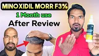Morr F 3% Minoxidil 1 Month After Review | Minoxidil hair growth result | @AvinashhJadhav