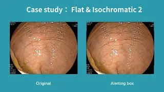 Real-Time Polyp Detection AI For Flat & Isochromatic Cases