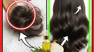  Apka 80℅ hair loss due to dandruff isko jldi theek krlo nahi to ganje ho jaoge #AyurvedicHairCare 