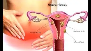 Genital tuberculosis-NBC