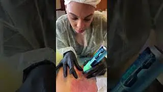 Inkless Stretchmark Camouflage Technique #stretchmarkstreatment #stretchmarksremoval #scarcamouflage