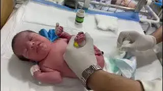 🍼Severe Abdominal Distension in Baby &mdash; Glycerine Suppository Given, Baby Passes Stool Successfully 🚼