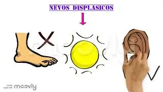 NEVOS DISPLASICOS