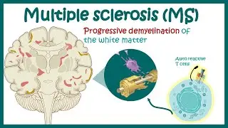 Multiple sclerosis | Types of Multiple Sclerosis | Causes, symptoms, diagnosis, treatment, pathology