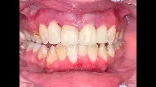 CEREC CeraSmart 7-10 Same Day Makeover