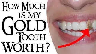 How Much is my Gold Tooth Worth?