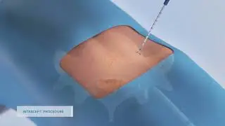 Intracept Procedure 3D Animation - Reno, Nevada