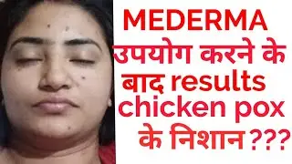Mederma cream after use .chicken pocks के निशान गये या नहीं  । full details