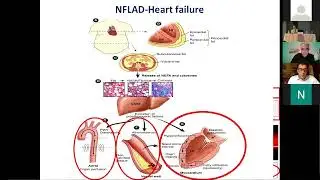 09. Sfikas G. - A 58-year patient with obesity, dyslipidemia and fatty liver disease