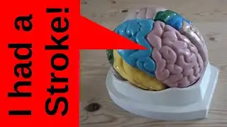 I had a stroke!