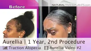 Hair Restoration Surgery is a Permanent Hair Loss Treatment for Women | Dr. Blumenthal (Aurellia)