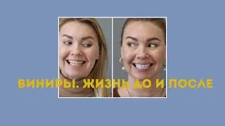 Виниры. Жизнь до и после