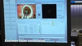 Femtosecond LASIK for Hyperopia correction - Nikos G. Tsioumas, MD