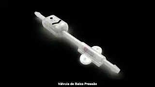 Revisão de válvula para Hidrocefalia em criança devido a hiperdrenagem.
