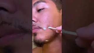 Couples Skincare Test: Tea Tree Drying Lotion vs Microneedling Patches | Bye Bye Blemish