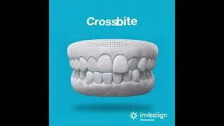 Invisalign&reg; Teen