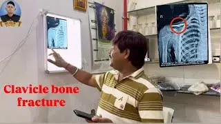 Clavicle compound fracture adjustment & chiropractor jai Bhagwan therapy centre Ajmer Rakesh Phalwan