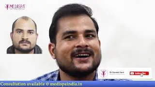 SUPER NATURAL HAIRLINE in Level 6 Baldness Hair Transplant at Medispa Dr Suneet INDIA Jaipur Delhi