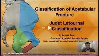 Understanding the Judet-Letournel Classification of Acetabular Fractures: A Comprehensive Guide