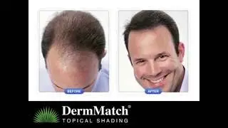 DermMatch Natural Hair Loss Concealer For Men & Women