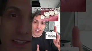 Tips to avoid dental bridge failure
