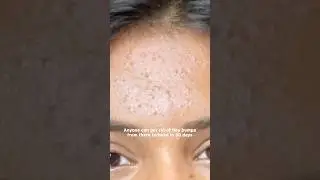 How to Get Rid of Tiny Bumps & Smooth Skin in 30 Days! #shorts #skincare #tinybumps #acne #acnetips