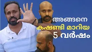 5 Year After Hair Transplantation 😍