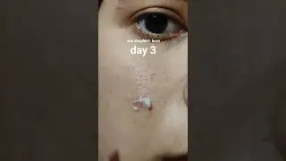 results 5 days of applying adapalene & benzoyl peroxide gel on cystic acne #acne #tretinoin #pimple