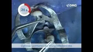 Perfekte post-endodontische Versorgung mit der LuxaCore-Familie