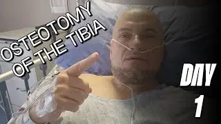 Osteotomy of the tibia (Остеотомия большеберцовой кости)