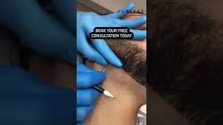 Dubai&rsquo;s Top Hair Removal Treatment That Actually Works |  Electrolysis at Furless Permanent