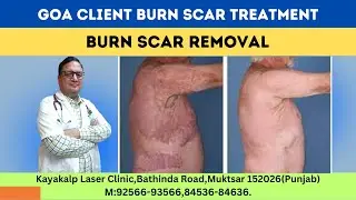 Goa Client Burn Scar Treatment |  Burn Scar Removal | Kayakalp Laser Clinic