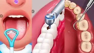 ASMR Dental Treatment Animation Satistfying Tartar & Caries Removal | Dental Care Animation