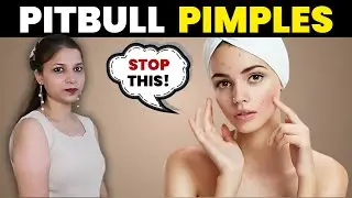 Why You Shouldn't Pop Your Pimples || By preetibella