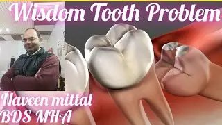 Wisdom Tooth Problem | Kab Aqal Daant Nikalwana Zaroori Hai? | Pain, Solution & Surgery