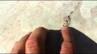 Calcium Nodule Removed