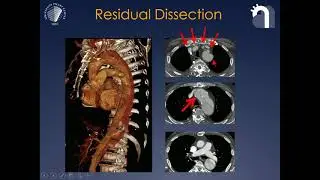 11.20-11.30: How I do Total Endovascular Aortic Arch Repair, Tilo Koebel, MD