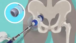 All You Need To Know About Robotic Assisted Total Hip Replacement