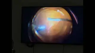 Vitrektomi p&euml;r shk&euml;putje retinale regmatogjene me &ccedil;arje 180&deg; &ndash; me sukses n&euml; Indian Eye Institute!
