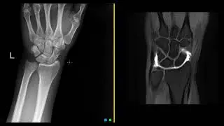 What is an MRI wrist arthrogram?