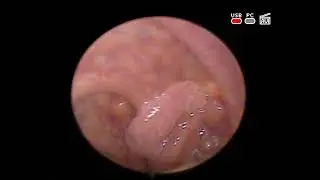 oropharyngeal #carcinoma on the background of palatine tonsil #papilloma ENT Kyiv #Ukraine