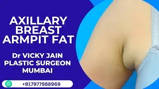 Axillary Breast:Causes,Symptoms & Treatment | How to Remove Armpit Fat #axillarybreast #dr vickyjain