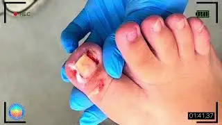 Soothing Foot Care Treatment for Stress Relief | Deep Cleaning & Ingrown Nail Care #14