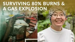 A Burn Survivor's Story: Life After Surviving 80% Burns & a Gas Explosion
