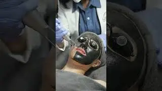 Promo! Carbon Blackdoll Laser Facial + Serum Treatment for Only Rp 450rb