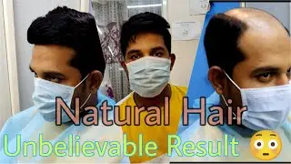 Hair fixing Bangalore 9986338144/ 8884927333 Flair Hair | Natural Hair Non-surgical