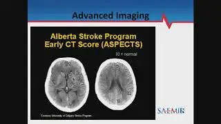 New Frontiers: Management of Acute Ischemic Stroke in the Extended Time Window (Up to 24 Hours)